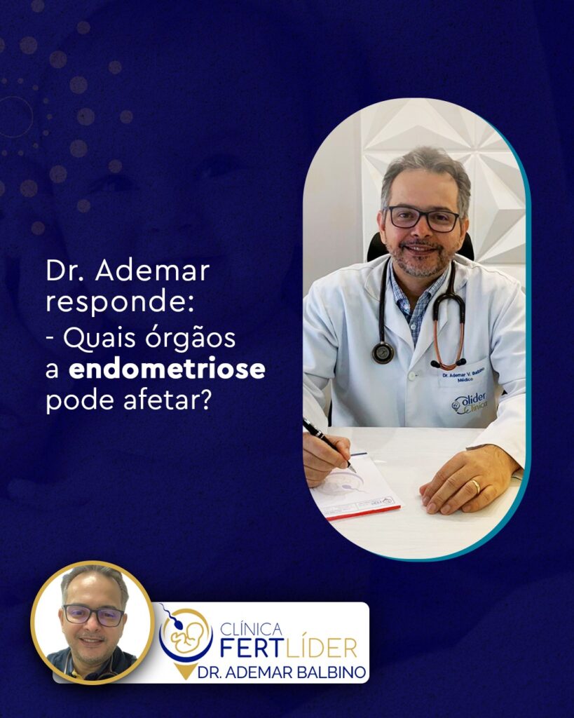 quais-orgaos-a-endometriose-pode-afetar-dr-ademar-balbino-colider-mt